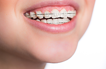 成人の矯正歯科 イメージ写真